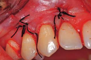 Primenom navedenih kliničkih parametara utvrđivano je stawe parodontnih tkiva, kao i nivo oralne higijene pre hirurškog zahvata i šest meseci od lečewa, kada je izvedena konačna procena (Slika 10).