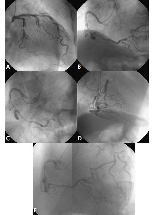 For Personal Use. Figure 1. Diagnostic angiography. (A) Severe luminal narrowing in middle left circumflex.