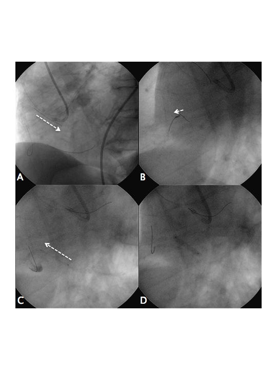 For Personal Use. Figure 3. Percutaneous coronary intervention for distal right coronary artery (RCA).
