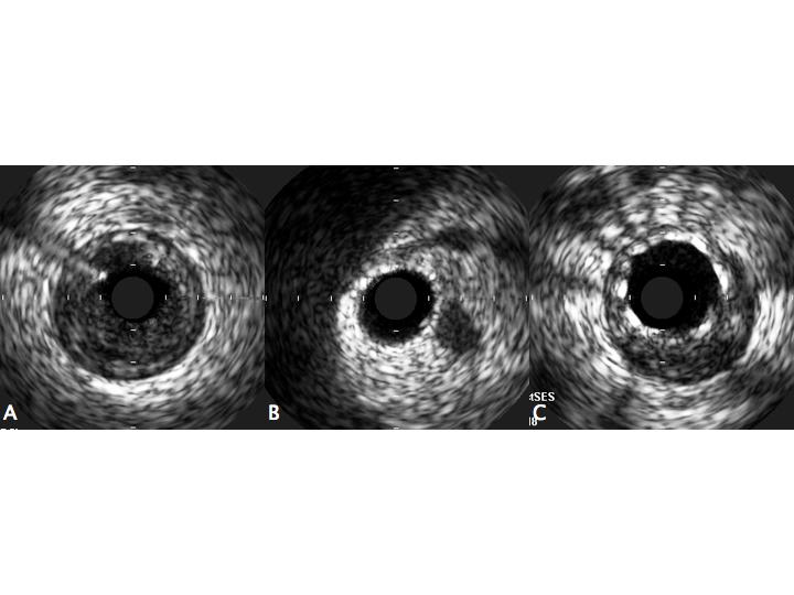 Figure 5. Intravascular ultrasound (IVUS) findings. (A) The preprocedural IVUS image of the distal right coronary artery (RCA) lesion showed a minimal luminal diameter of less than 2.