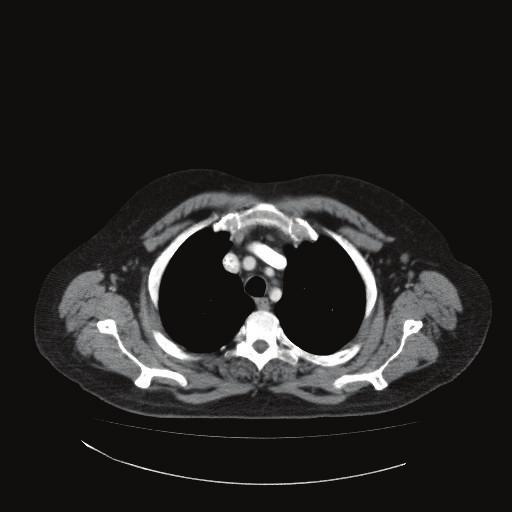 bilateral axillary lymphadenopathy; (b) illustrated CT of the