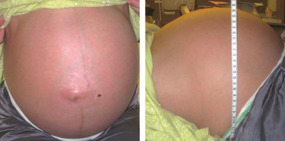 4 Fig. 1 Polyhydramnios at 30 weeks of gestation. 10 minutes, respectively. The female baby was alert and breathing spontaneously.