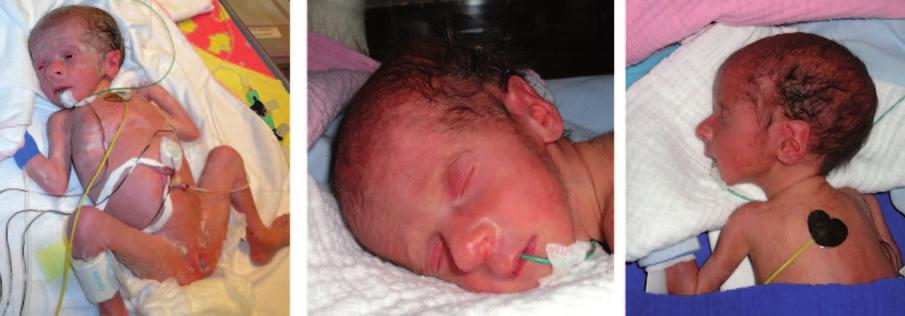 6 Fig. 3 The newborn infant after birth: triangular face and asymmetrical growth restriction. was transiently increased up to a maximum level of 30 mmol/l on day 8 of life.