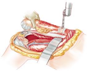 Femoral Osteotomy All remaining soft tissue at the level of transection is cleared.