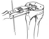 NOTE: It is important that the correct size be selected to fully support the all-poly tibial component around the periphery with cortical bone.