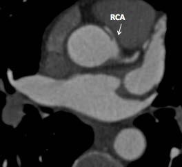 Anomalies of Origin and Course: Aberrant RCA Image from CT coronary angiography in 25 year old male (screening study) demonstrating right coronary artery arising from the left coronary sinus and