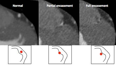 Anomalies of Intrinsic Anatomy: Myocardial Bridging Band of myocardial muscle overlies coronary artery segment Typically mid segment of LAD Partial or full encasement Often better appreciated on CT