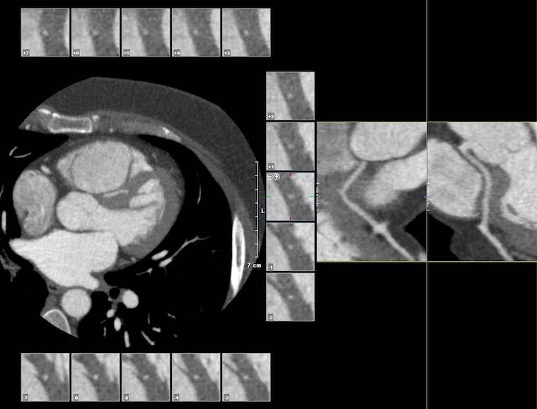 Anomalies of Intrinsic Anatomy: Myocardial Bridging CT coronary angiogram in 34 year old female with