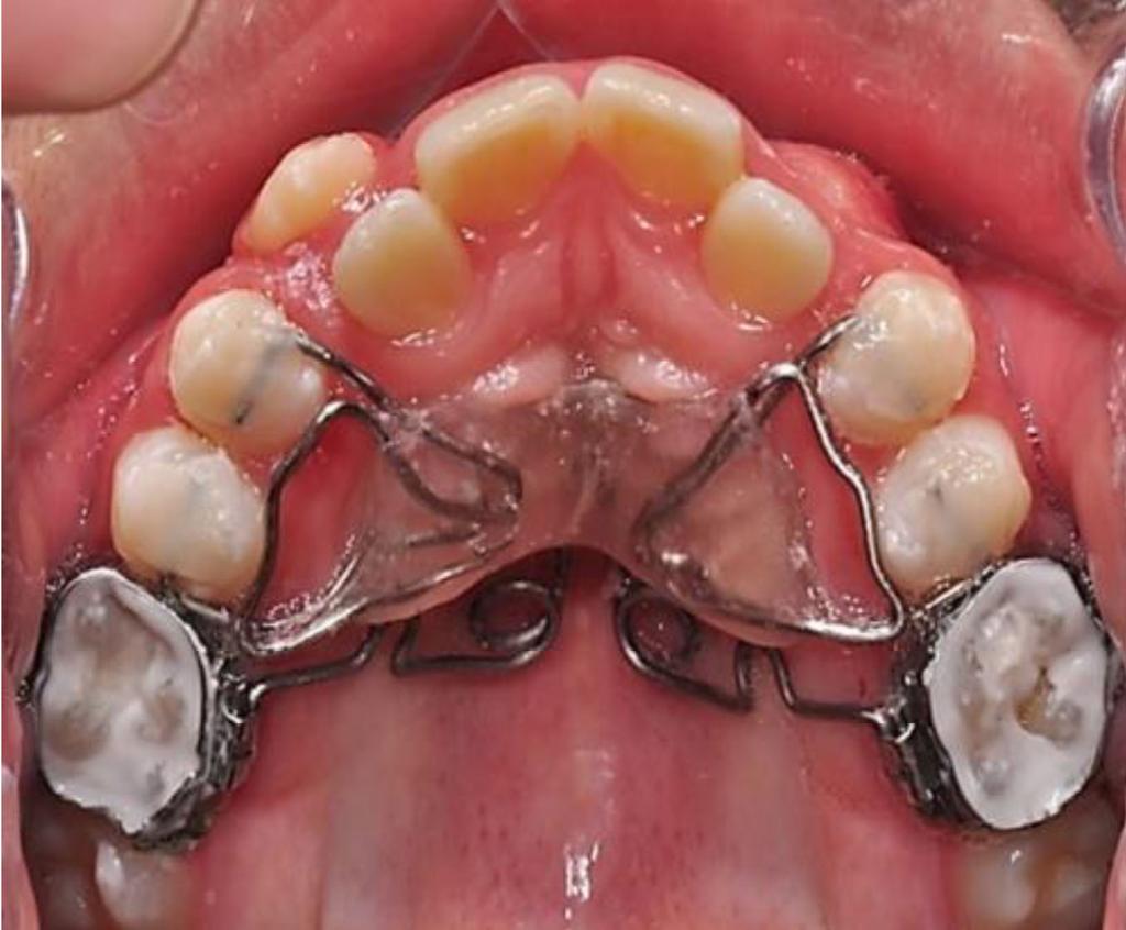 AIM Our objective is to find out if borderline cases in orthodontics can be solved with a combination of appliances achieving results in different planes.