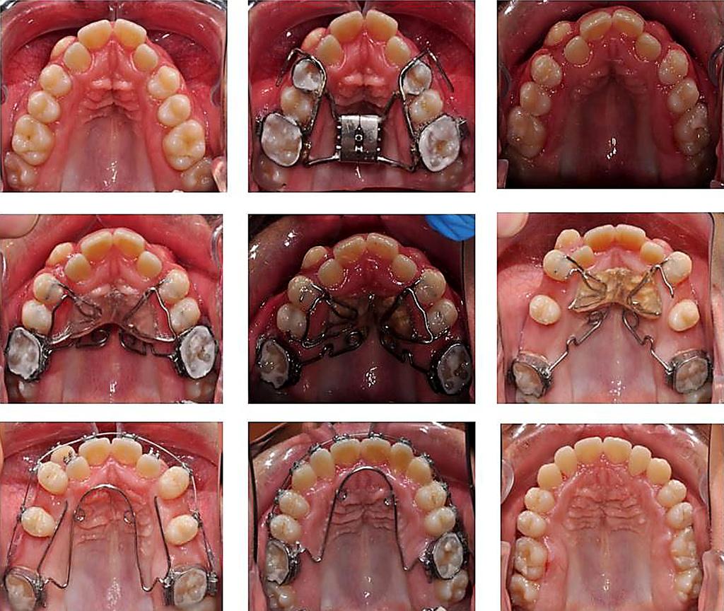 After the three stages of the orthodontic treatment we resulted in making space in the upper dental arch for levelling the teeth, the occlusal reletationships went to normal in the tree plates, and
