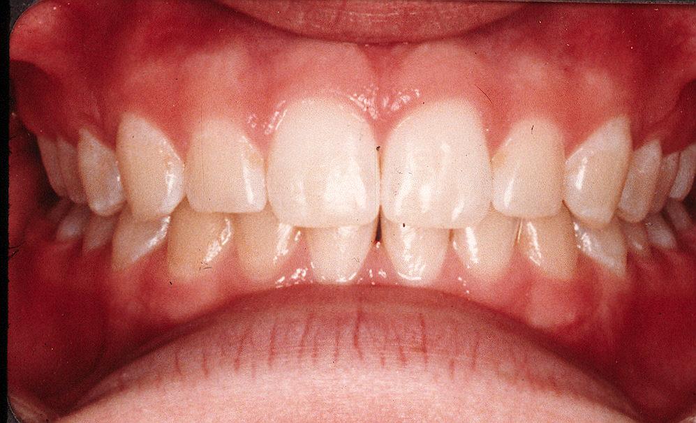 Goal # 4 : Healthy Occlusion (how the teeth fit) Each tooth has a slight inclination It is crucial that the front