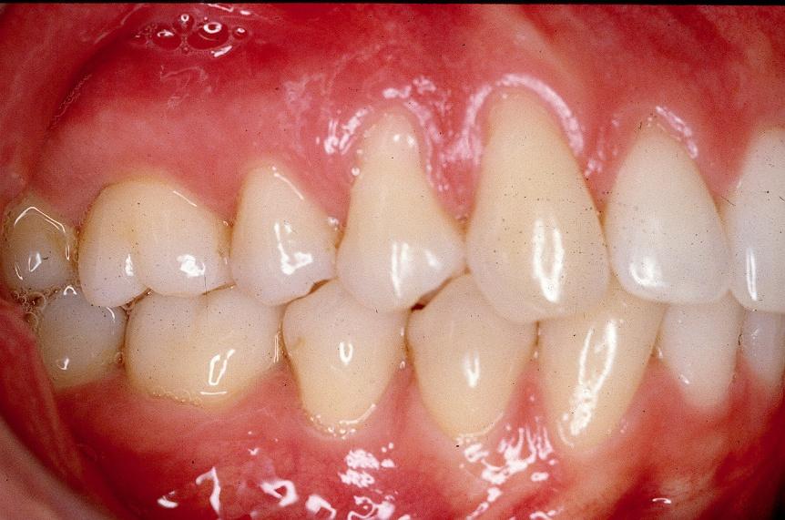 Goal # 5 : Healthy Periodontium (supporting gums & bone) If the joints are correctly