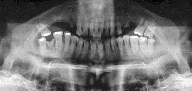 Clinical and radiological examinations revealed left posterior crossbite, right mandibular ramus elongation, leftward chin deviation, absence of both mandibular first molars, extrusion of the upper
