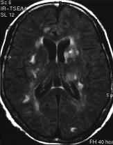 46 MRI Findings of Meningoencephalitis of Angiostrongyliasis with delirium status and stool incontinence were encountered.