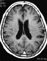 A small spot with high signal intensities 1a 1b 1c 1d 1e 1f Figure 1. A 79-year-old woman with eosinophilic meningoencephalitis. a.