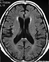MRI Findings of Meningoencephalitis of Angiostrongyliasis 47 2a 2b Figure 2. Follow-up MR examination 8 months later. The FLAIR a. and gadoliniumenhanced T1-weighted b.