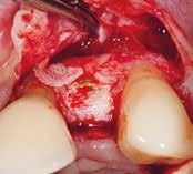 Defect was filled with slow-resorbing bone graft