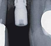 bone. The implant could be placed in the prosthetically