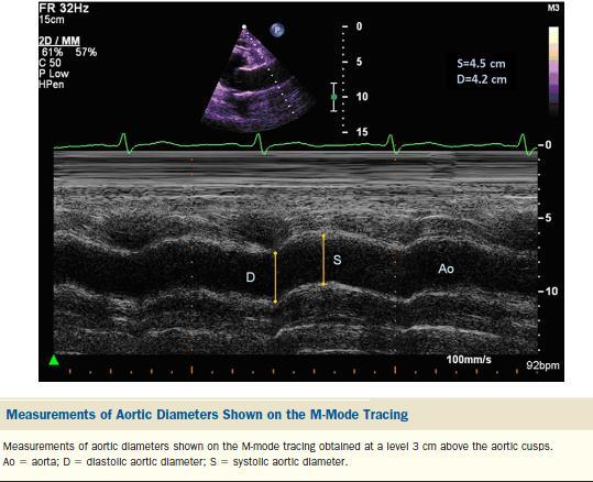 Aortic Distensibility (in cm 2 dyne -1 10-6 ) = 2(systolic diameter
