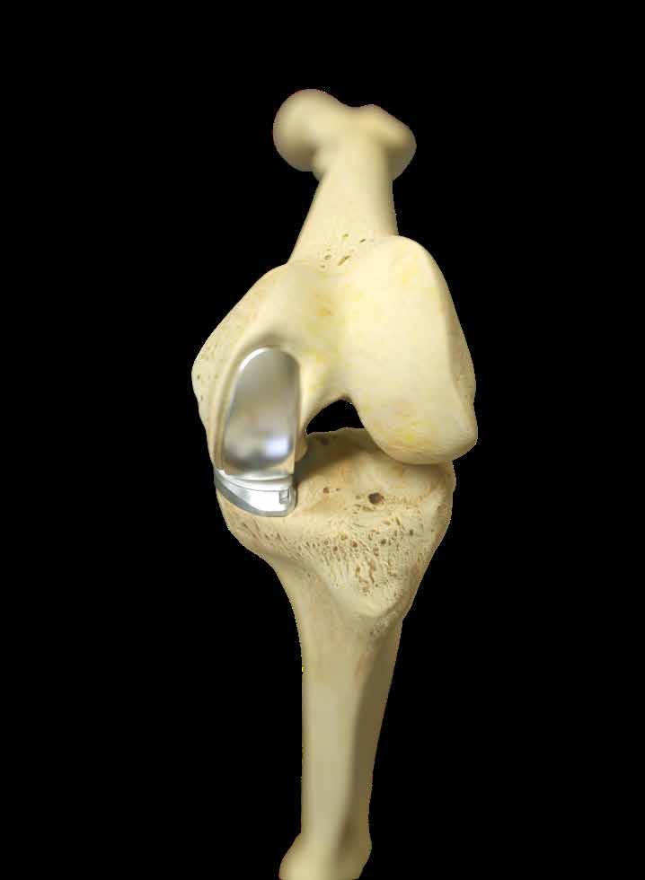Partial knee replacement Partial knee replacement is a potential alternative to total knee replacement for patients with early to mid-stage osteoarthritis that is generally limited to one compartment