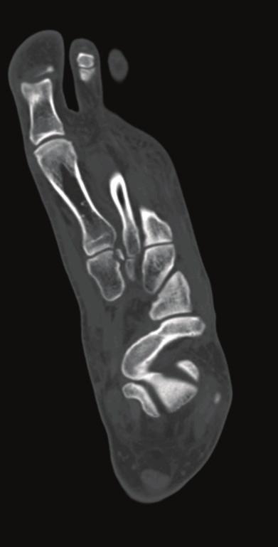 2 Case Reports in Medicine (a) (b) (c) Figure 1: (a) Axial CT images at the level of the midfoot show a Lisfranc fracture of the medial cuneiform.