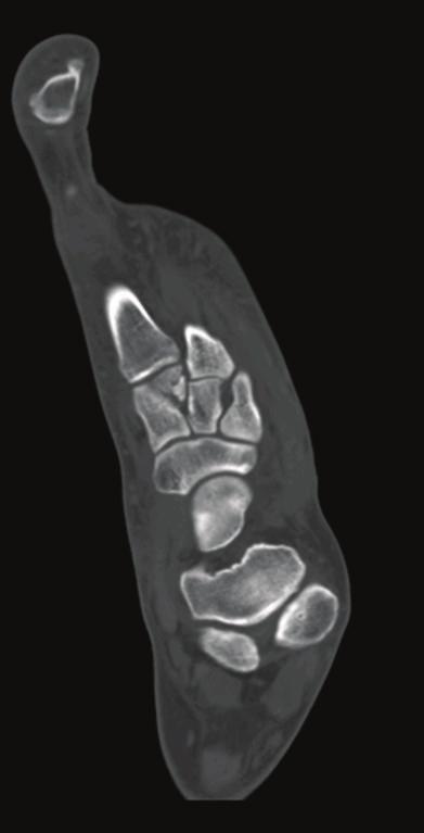(b) Coronal CT image at the level of the midfoot demonstrating the plantar (solid arrow) and dorsal (dashed arrow) segments of the bipartite medial cuneiform.