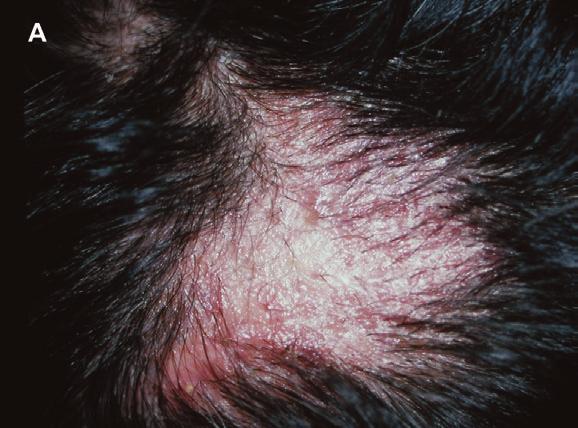 to be circumscribed in 75% of the cases and diffuse in 25%. 3 Successful treatment of the psoriasis stopped the hair loss and cured most cases of alopecia.