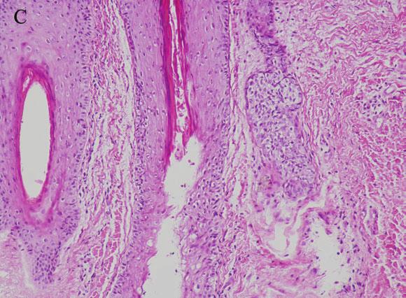 5 We report two cases of psoriatic scarring alopecia: one in a patient with chronic plaque type psoriasis and the other in a patient with pustular psoriasis.