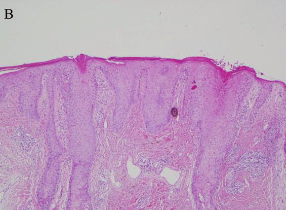 CASE REPORT Case 1 A 57-year-old man has suffered from chronic plaque psoriasis for 28 years. He also has psoriatic arthropathy affecting both spinal and peripheral joints with joint deformity.