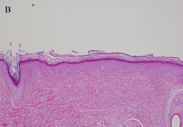 The interfollicular epidermis was normal and no perifollicular inflammation was seen (Fig. 2B). There was an increased telogen/anagen ratio (3/3).