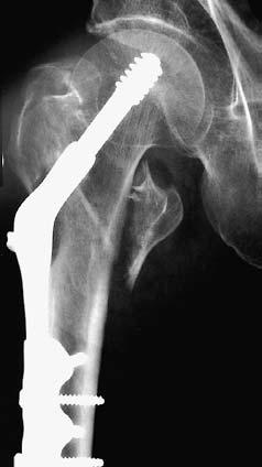 576 O. OLSSON, L. CEDER, A. HAUGGAARD Table IV. Details of five cases of postoperative failure of fixation.