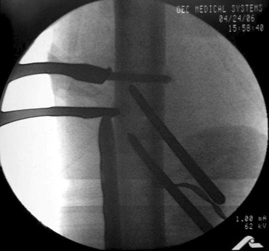 When surgeons see just the AP image of C-arm fluoroscopy during the procedures, they make mistakes such as shortening because of flexion deformity of the distal femur. Fig.