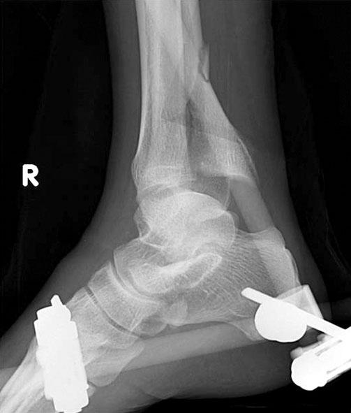 2 showed a 40-year male patient who received TBEF for soft tissue swelling and blister formation after pilon fracture. The patient did complain about continuous paresthesia in the heel area.