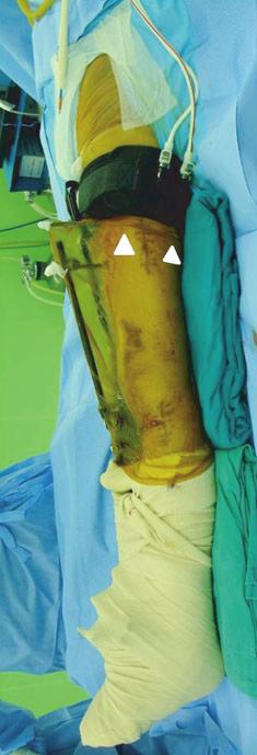 Since the half pin had been placed for more than 2 weeks, pin site debridement was performed and the location of the half pins was changed from the lateral thigh to the anterior thigh.