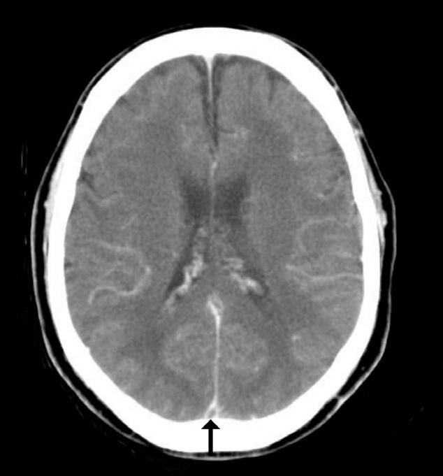(B) Enhanced brain CT reveals an empty delta sign (arrow). A B C Figure 2.