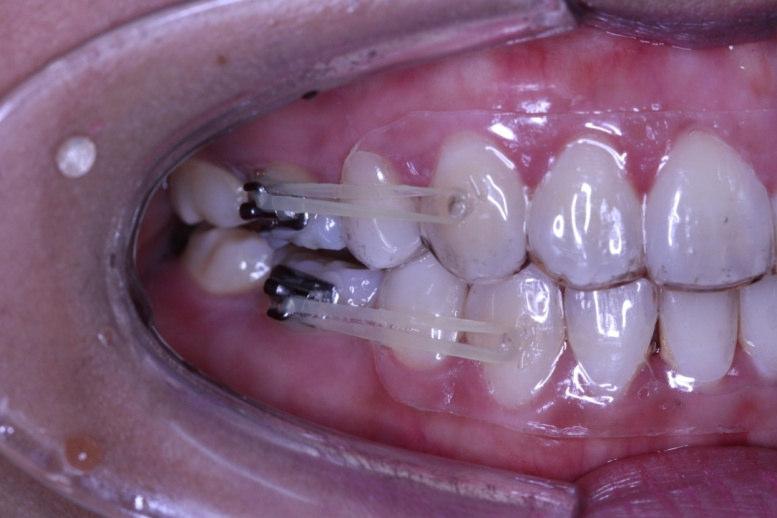 appliances. However, both methods would incur some additional cost to patients. By using patients own retainers and buccal tubes this could offer an alternative and cheap way to treat relapse cases.