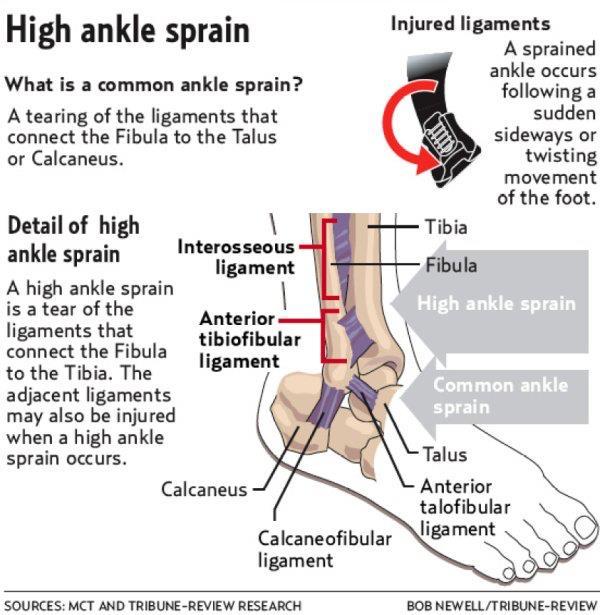 High ankle sprain High ankle sprains: