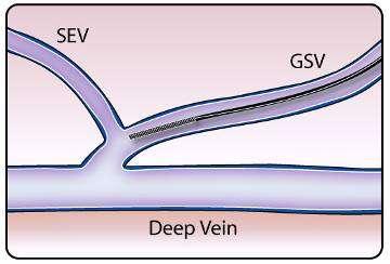 Catheter Advancement and Positioning Obtain longitudinal view of