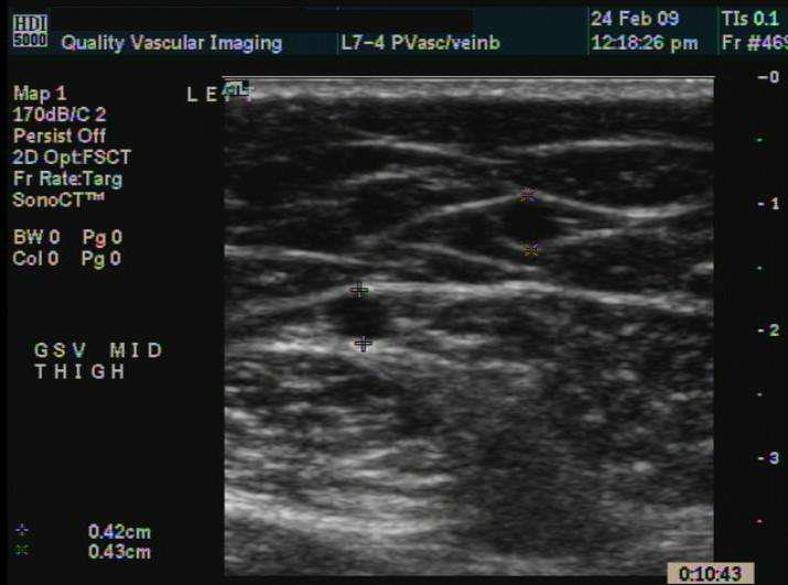 Great Saphenous vein with