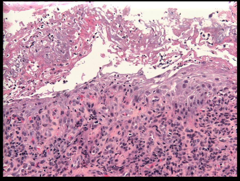 erosions: granulation tissue covered by thinned,