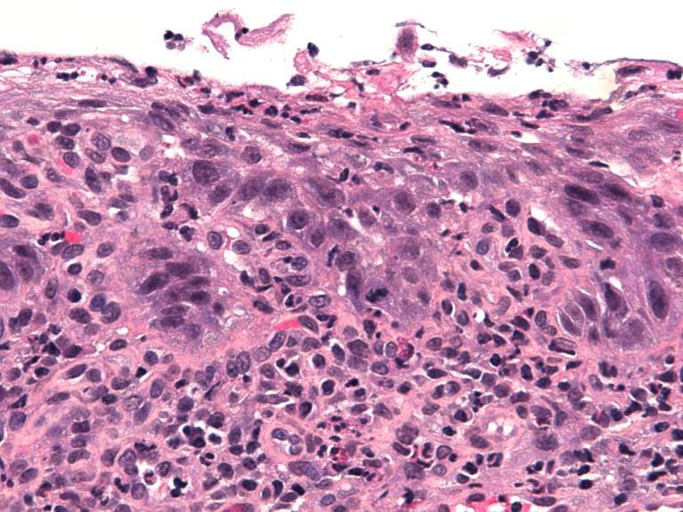 mitoses Dysplasia cytoarchitectural pleomorphism absent, sharply angulated, or markedly irregular papillae