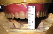 If the planar reduction is misdirected, the resultant tilt of the bar structures may create reduced or insufficient room for arranging teeth and processing.