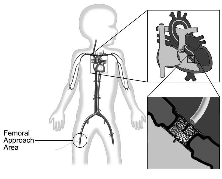 Figure 4. Left-sided Approach. 10. Advance the delivery sheath and dilator over the guidewire until the tip of the dilator crosses the VSD. 11. Remove the dilator. 12.