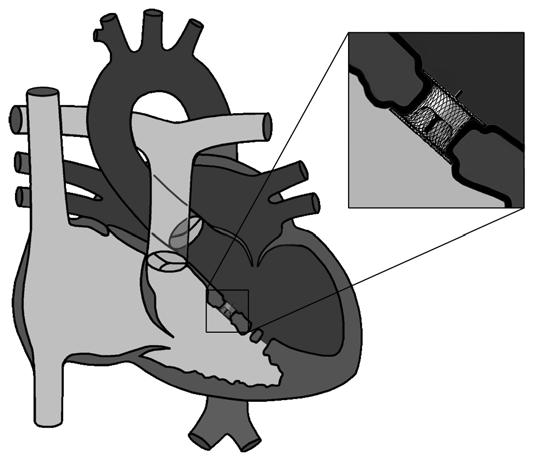 Figure 5. Placement of the AMPLATZER Muscular VSD Occluder. 23.