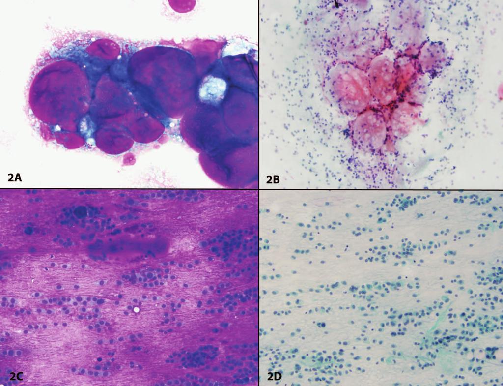 Figure 2. Fine-needle aspirates of adenoid cystic carcinoma (A, B) and pleomorphic adenoma (C, D).