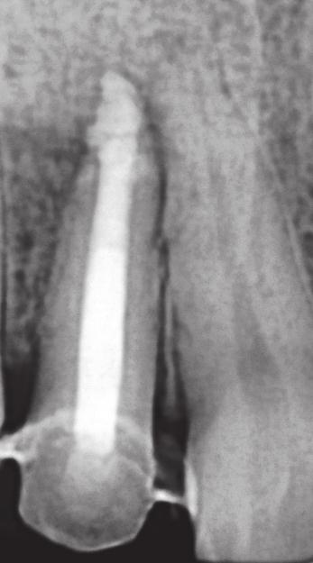 The chief complaint was pain with tooth #12. She presented with a history of root canal treatment with the same tooth 2 years back. Medical history was not contributory.
