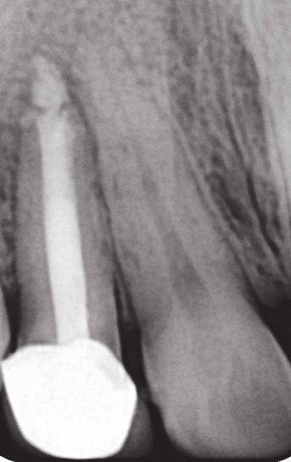 Radiographically, tooth #12 showed periapical rarefaction measuring approximately 2 mm (width) 4 mm (height), with a resorbed apex (Figure 1(a)).
