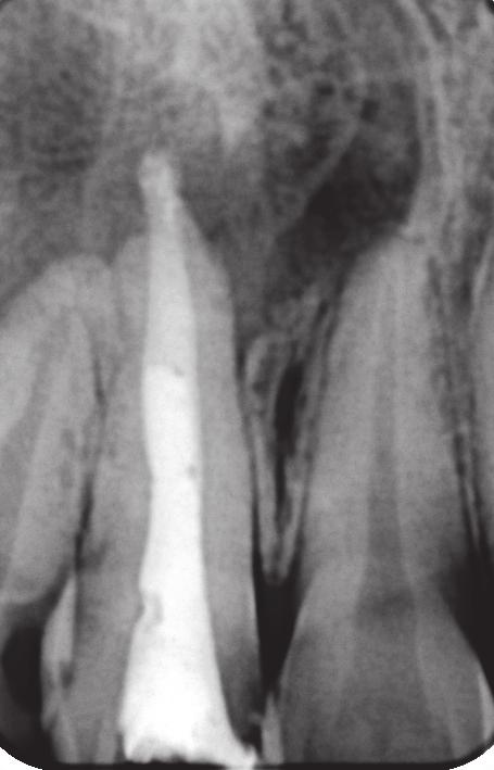 A 30-year-old female patient reported to the Department of Conservative Dentistry and Endodontics with the complaint of pain associated with the left maxillary central incisor (tooth #21).