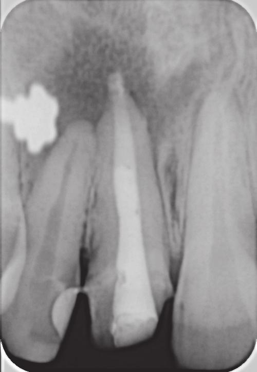 Radiographic examination revealed open apex of tooth #21 associated with a large periapical lesion of about 8 mm in diameter (Figure 2(a)).
