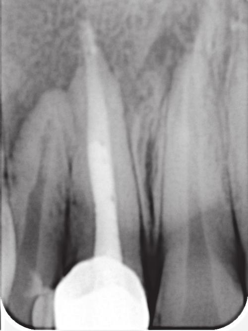 A diagnosis of chronic apical abscess with incompletely formed apex of tooth #21 was made, and nonsurgical endodontic treatment was planned.